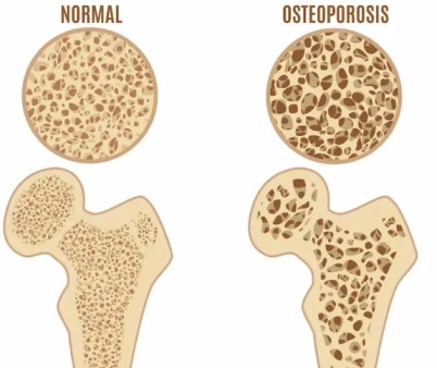 Osteoporosis Treatment